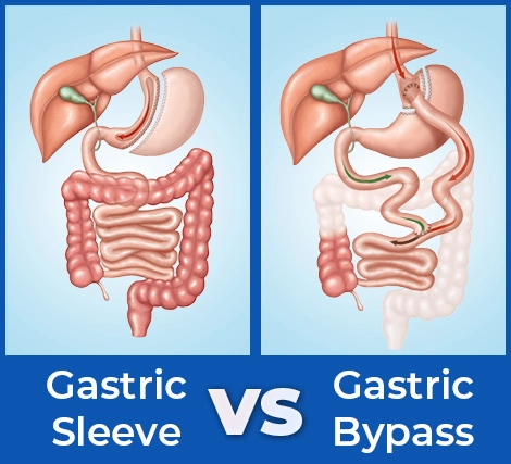 Gastric Sleeve Vs. Gastric Bypass: Understanding The Differences And ...